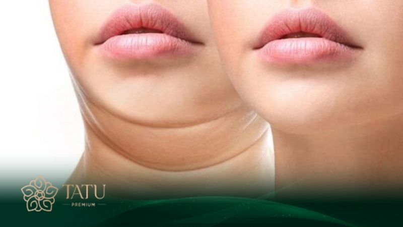 Chỉnh dáng cằm thon gọn bằng phương pháp tiêm tan mỡ