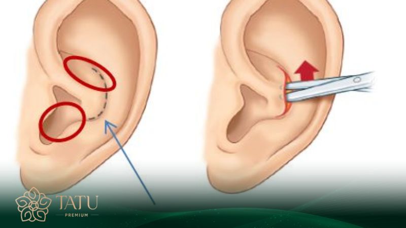 Nâng mũi bằng chất liệu sụn tai tự thân